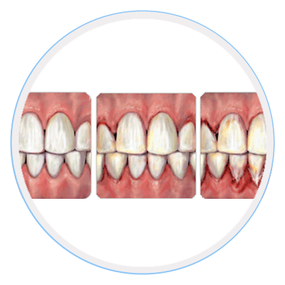 gingivitis