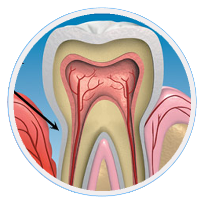 badbreath-gingivitis