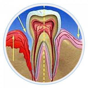 Gingivitis