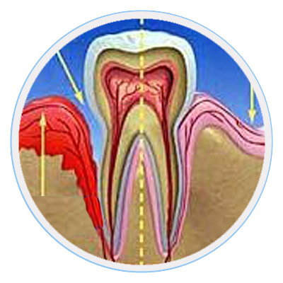 Gingivitis