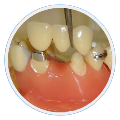 dental-bridges