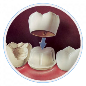 Dental-crown-Melbourne