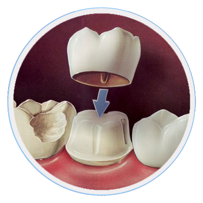 Dental-crown-Melbourne