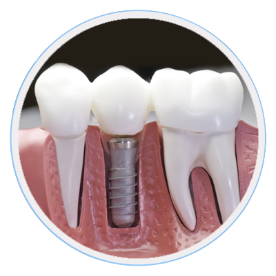 dental-implants