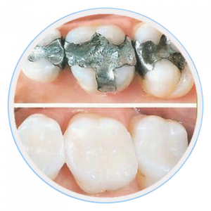 dental-fillings