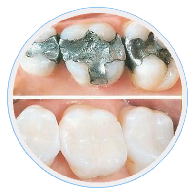 dental-fillings
