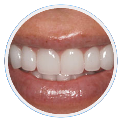 gummy-smiles