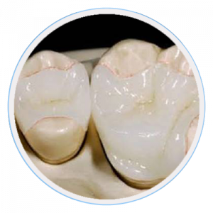 inlays-onlays