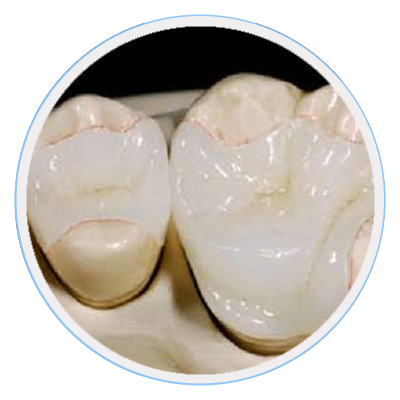 inlays-onlays