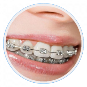 Braces Melbourne