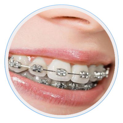 Braces Melbourne