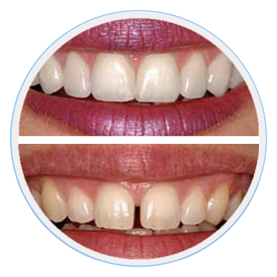 porcelain-veneers-melbourne