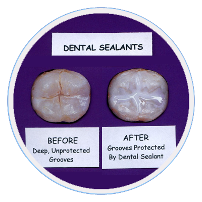 dental-sealants-melbourne