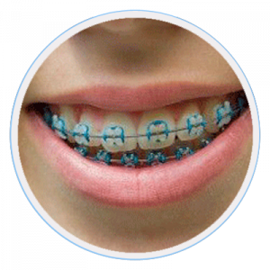 Straightening-Teeth