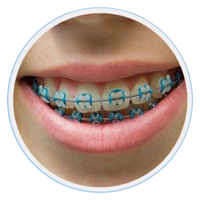 Straightening-Teeth