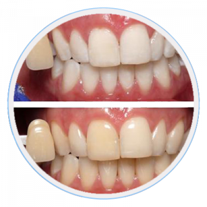 teeth-whitening