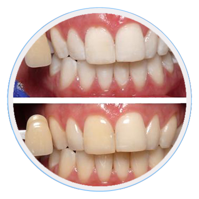 teeth-whitening