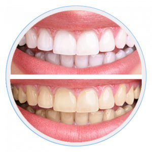Teeth Whitening Moorabbin