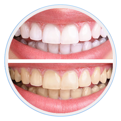 Teeth Whitening Moorabbin
