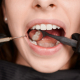 teeth-grinding